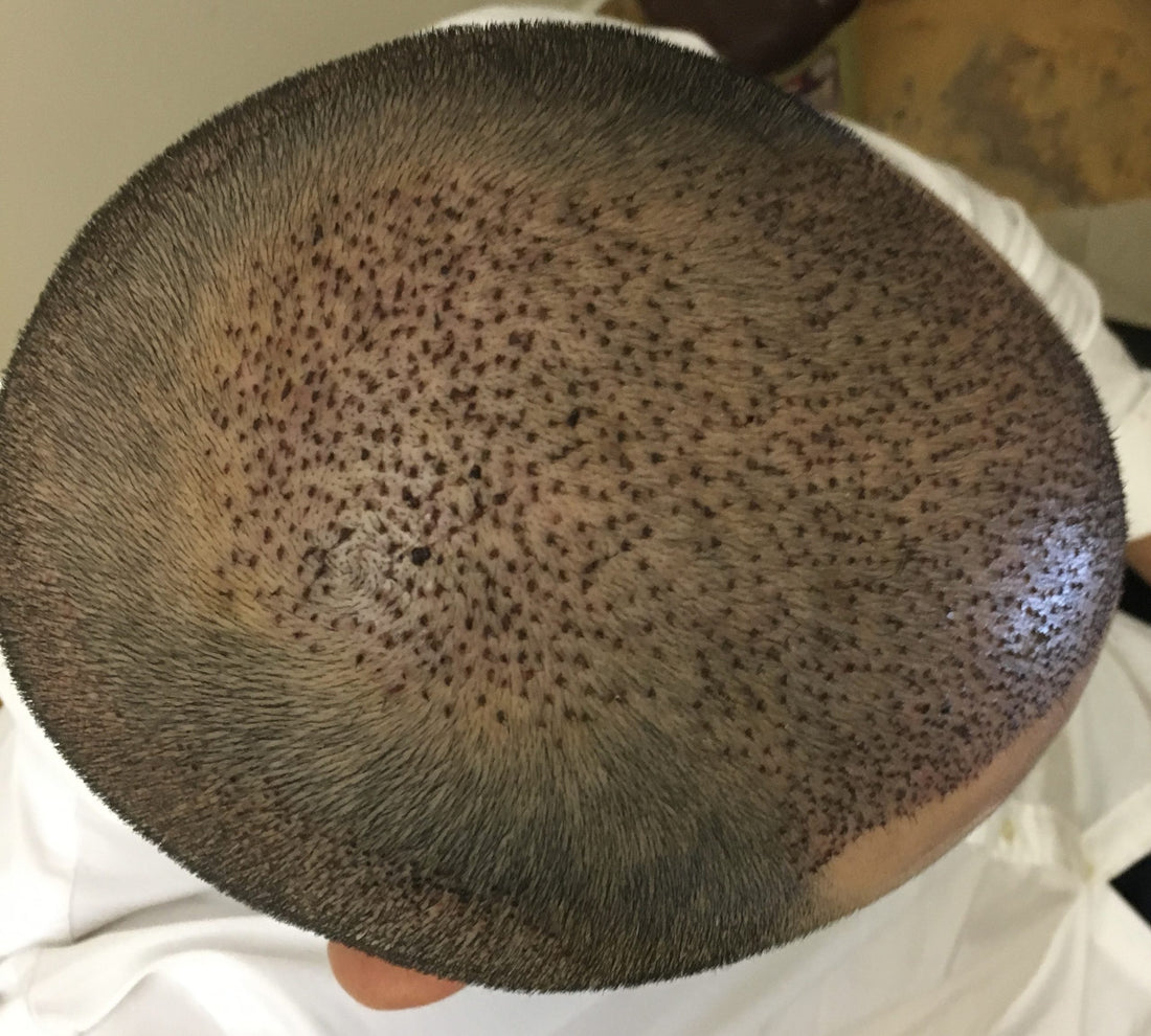 What haircare is needed after hair transplant?